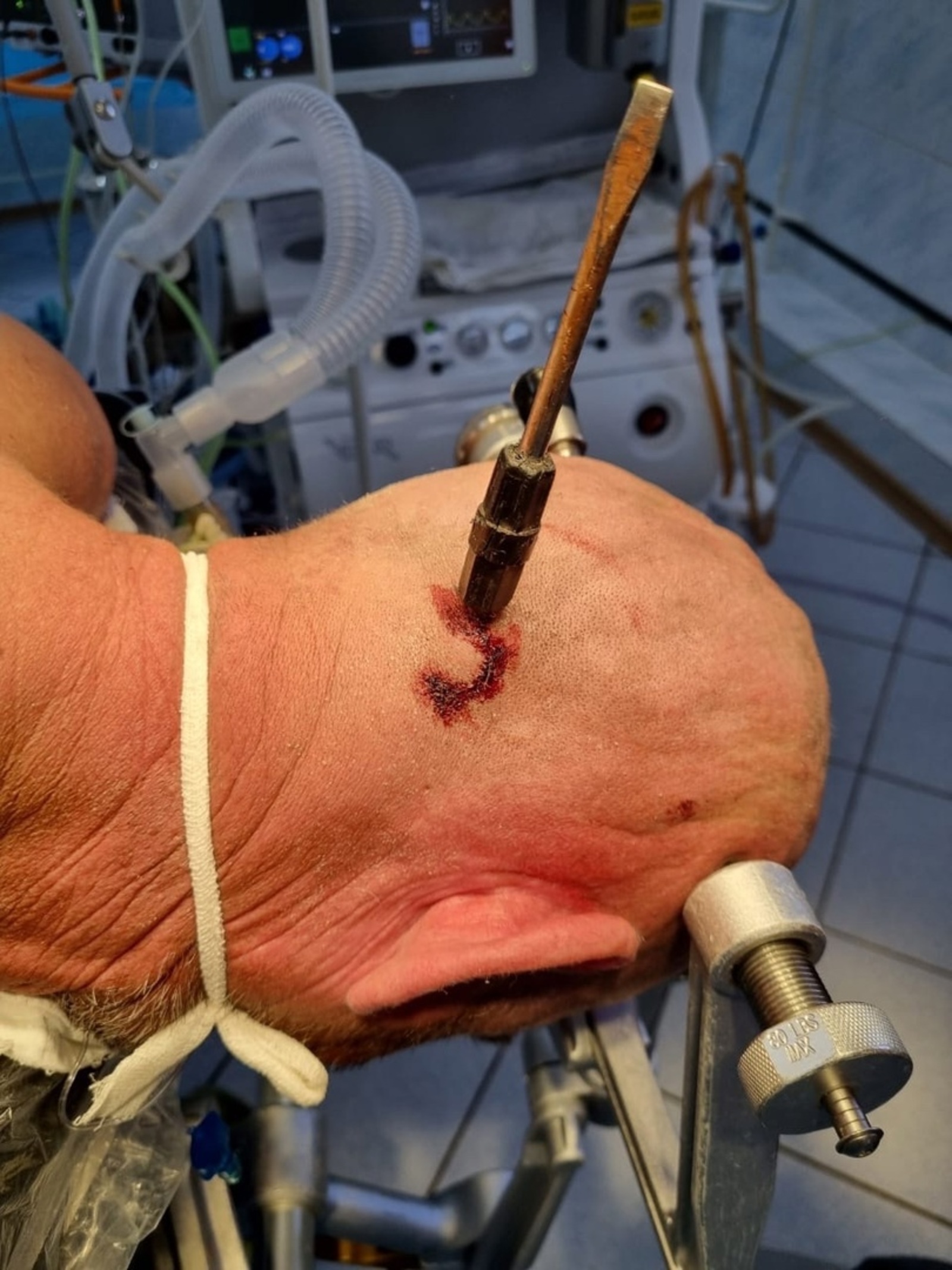 В Башкирии врачи вытащили отвёртку из головы мужчины