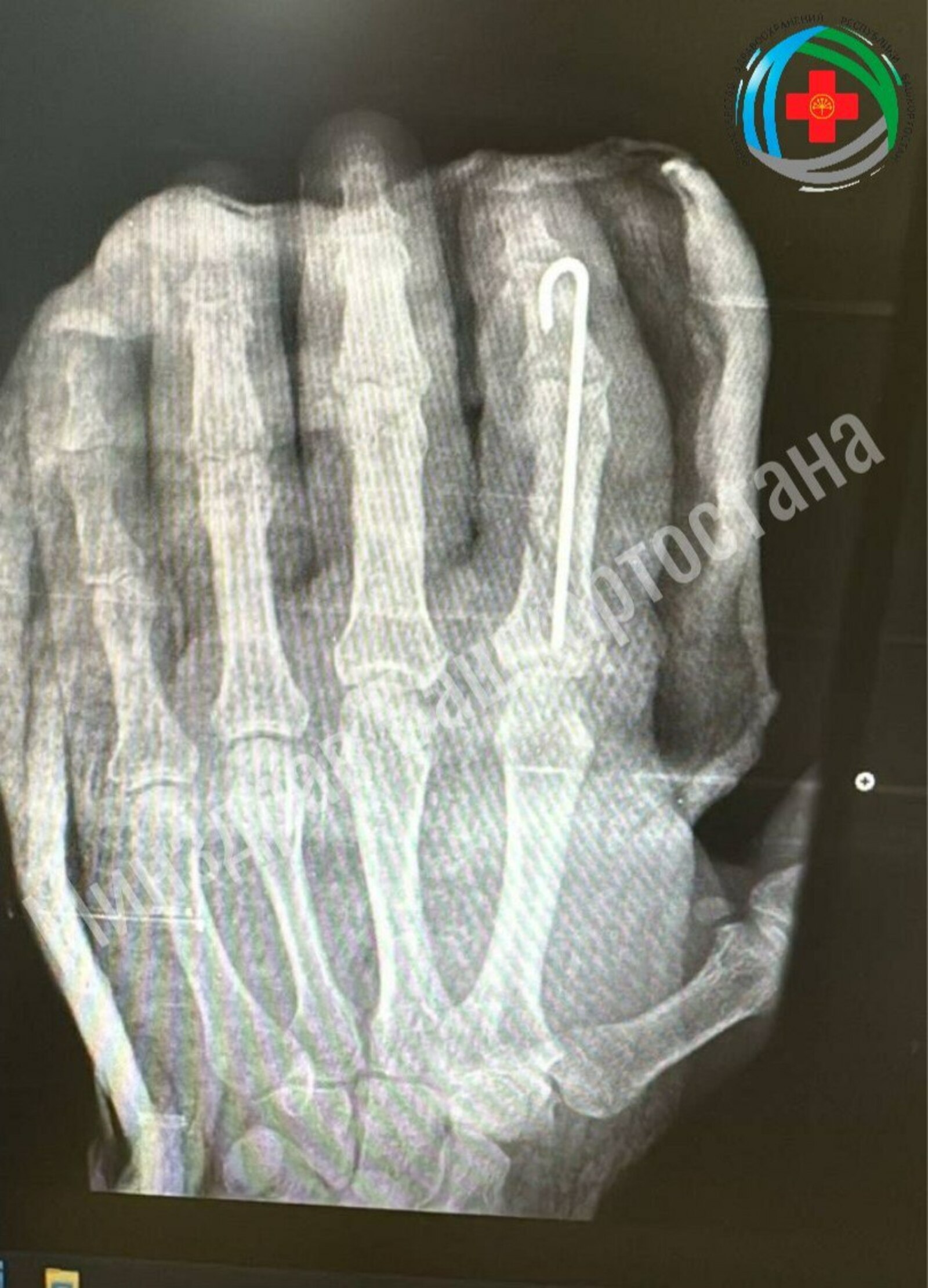 В Башкирии врачи пришили мужчине отрубленный палец