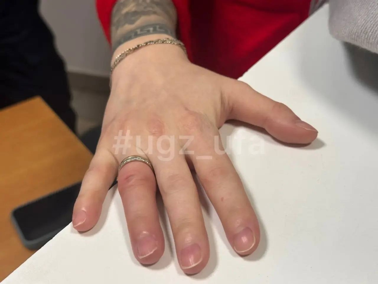 В Уфе кольца с пальцев беременной женщины сняли спасатели