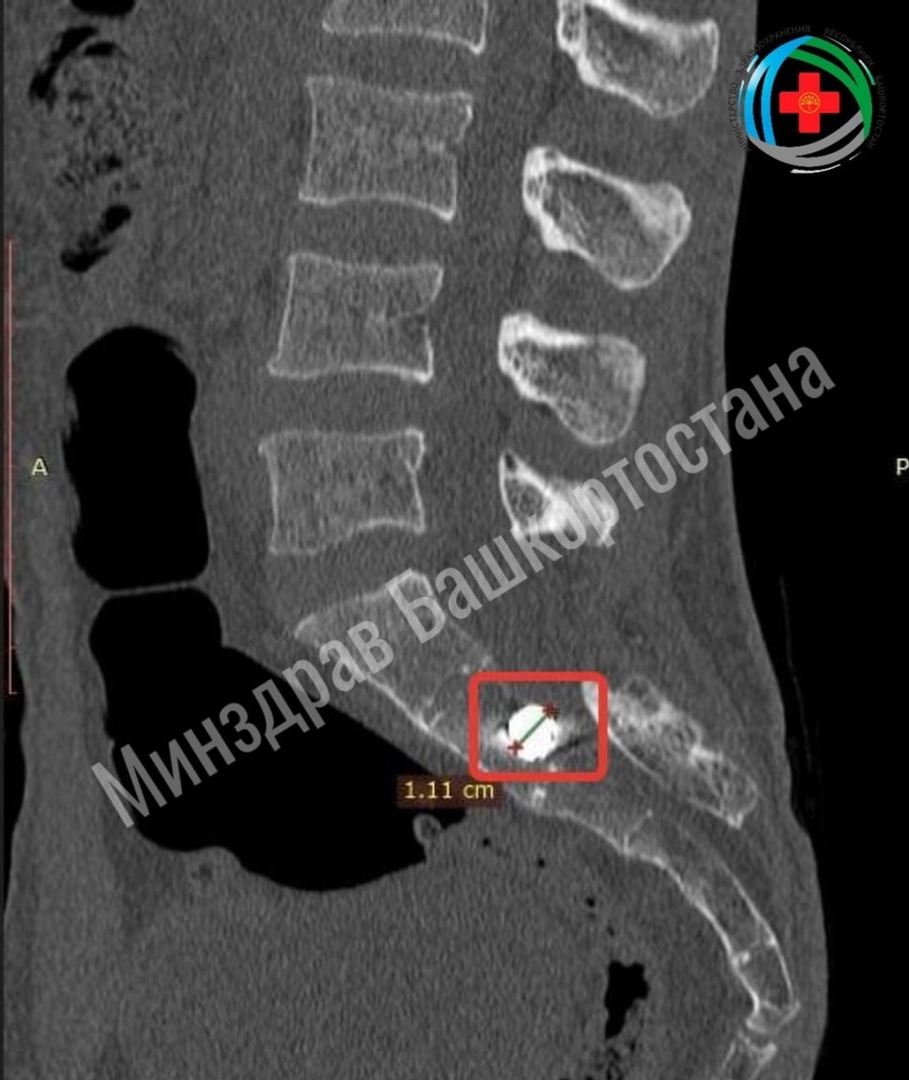 В Башкирии медики поставили на ноги бойца СВО, получившего осколочное ранение